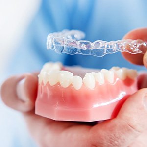 Dentist holding mouth mold and placing a clear aligner on top of teeth