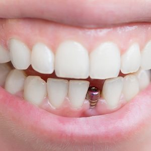 Closeup of teeth with implant in lower arch