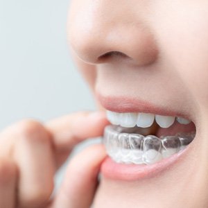 Woman holding clear aligner in her mouth
