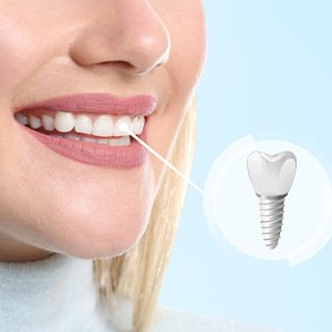 Nose-to-neck view of woman smiling with tooth indicated as implant