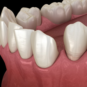Illustration of gapped teeth