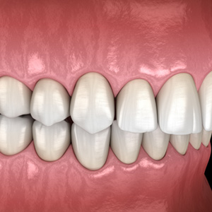 Illustration of an overbite