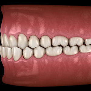Illustration of an underbite