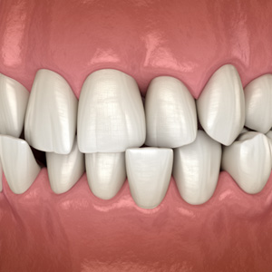 Illustration of a crossbite