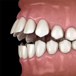 Illustration of an open bite