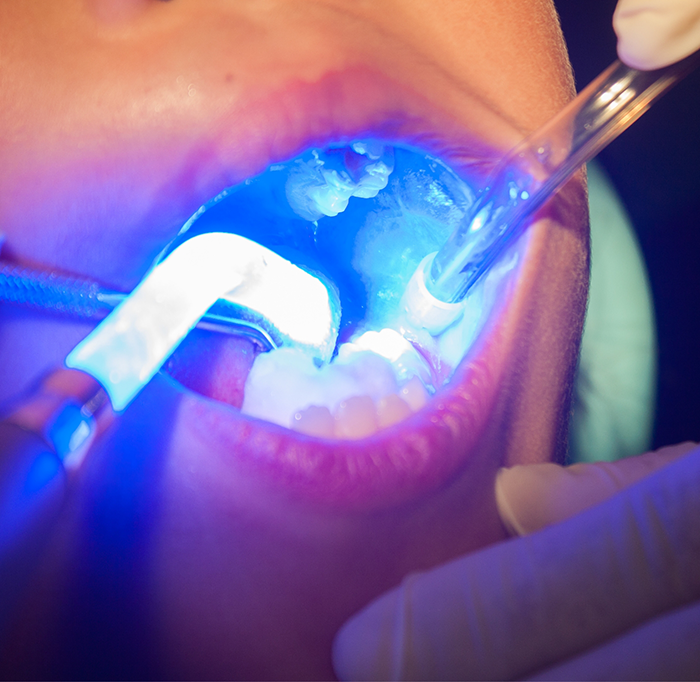 Special lights being used to harden dental sealants in place in patients mouth