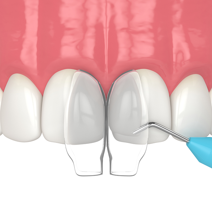 Cosmetic bonding being performed on upper teeth