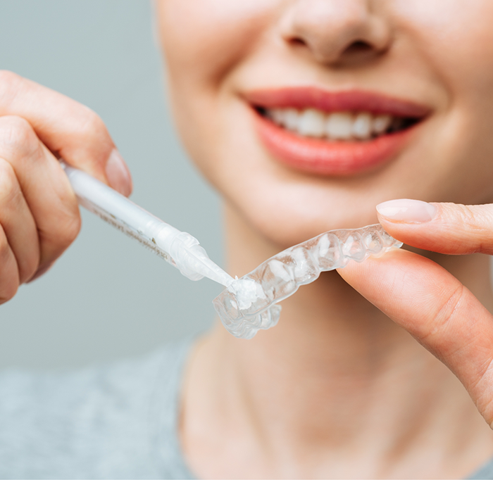 Woman holding tray and filling it with whitening gel