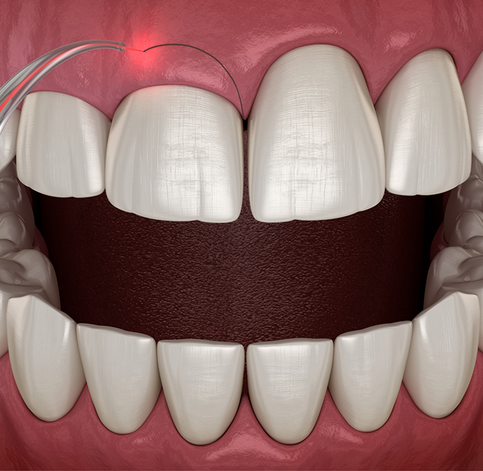 Illustration gum recontouring with a dental laser