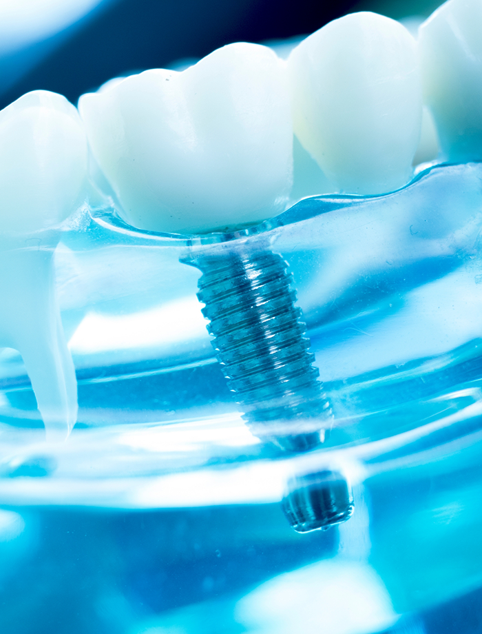 Close up of dental implant in Idaho Falls in plastic tray