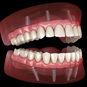 Illustration of implant dentures