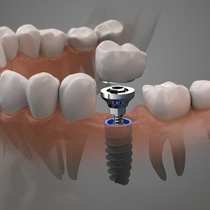 Example of dental implants in Idaho Falls