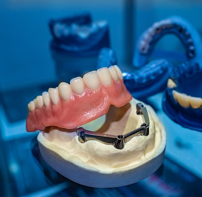 Close up of dentures and dental implants