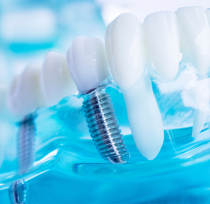 Close up of dental implants in plastic tray