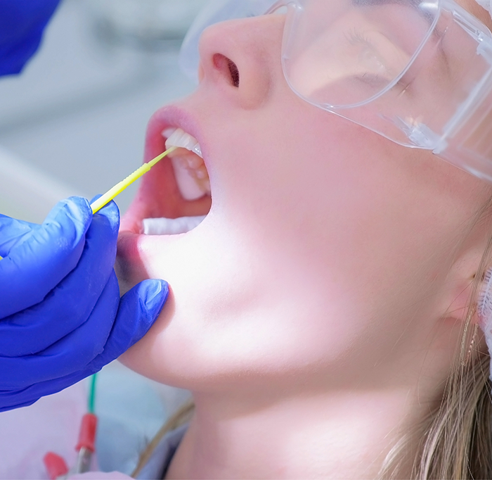 Applying fluoride to patients upper teeth