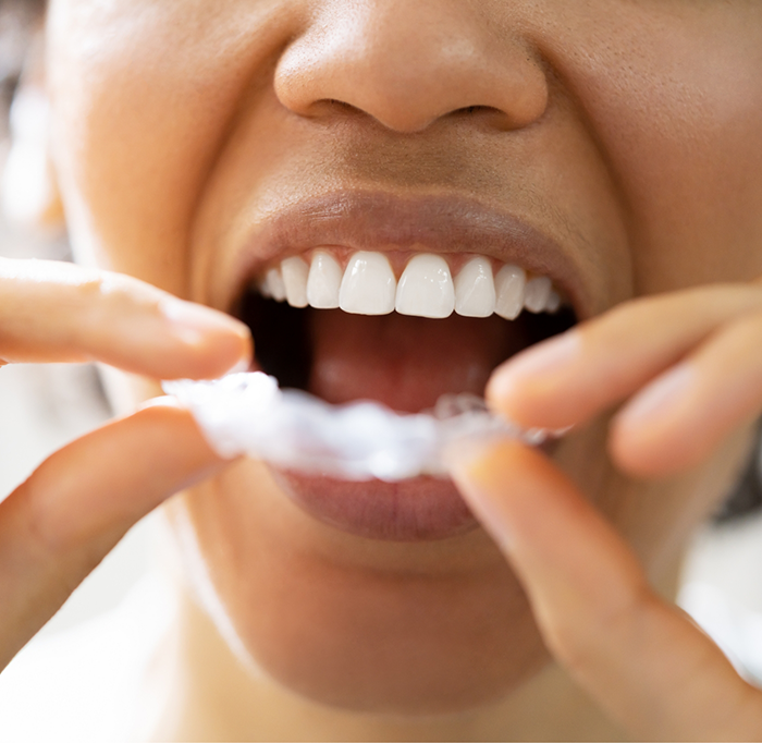 Woman about to put in a nightguard for bruxism