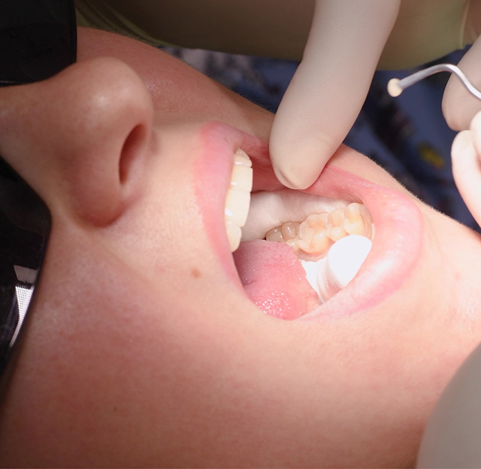 Close up of patients mouth while filling is being placed