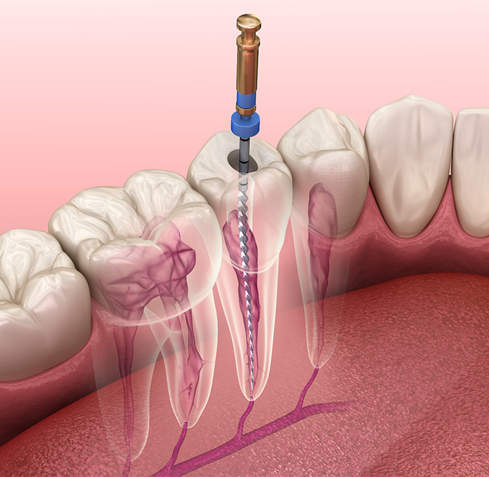 Illustration of root canal treatment in Idaho Falls