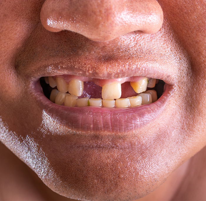 Close up of smile with multiple missing teeth