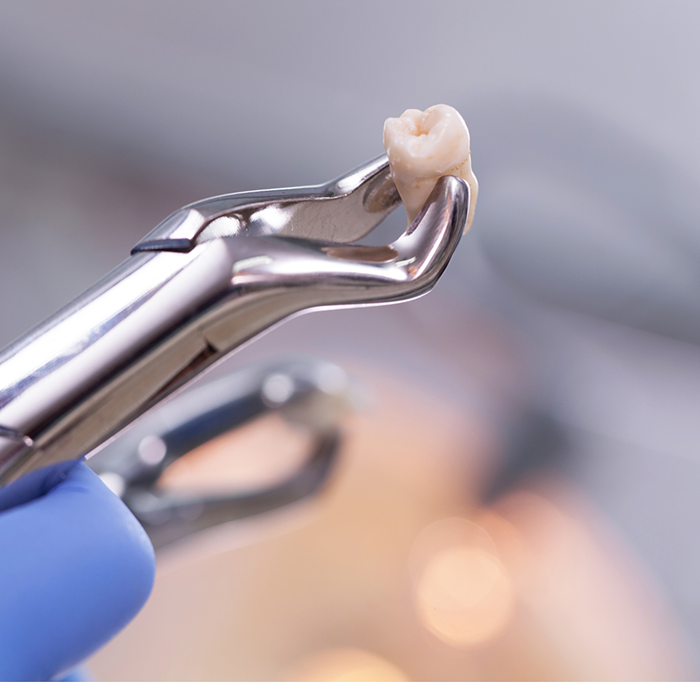 Close up of forceps holding a tooth