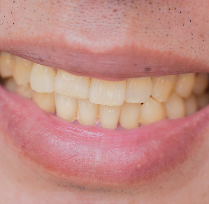 Close up of smile with yellowed teeth